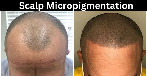 scalp micropigmentation wimbledon|Guide to Scalp Micropigmentation .